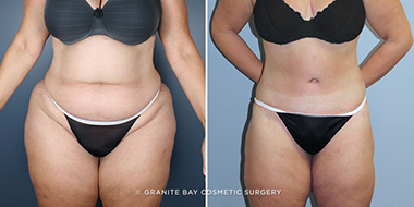 Tummy Tuck Incisions & Scars  Granite Bay Cosmetic Surgery