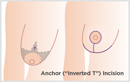 An anchor breast lift corrects significant sagging with one additional, concealed scar beneath the breast.