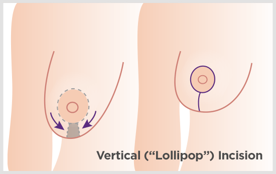 A vertical breast lift leaves a thin scar on the bottom half of the breast. It fades nicely with proper care.