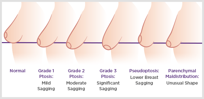 Granite Bay Breast Lift Surgery