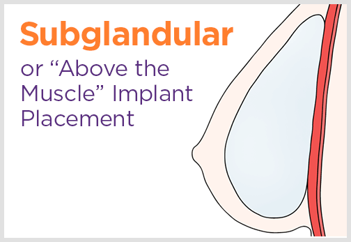 Subglandular Implant Placement