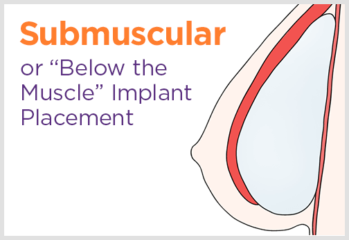 Submuscular Implant Placement