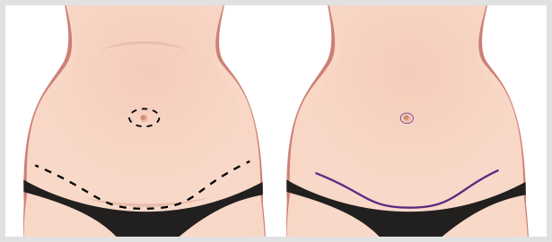 https://www.granitebaycosmetic.com/wp-content/uploads/2016/08/tummy-tuck-incisions.png