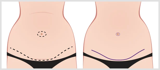 Tummy Tuck Incisions & Scars  Granite Bay Cosmetic Surgery