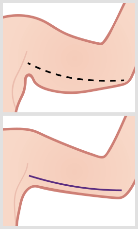 Arm Lift Incision