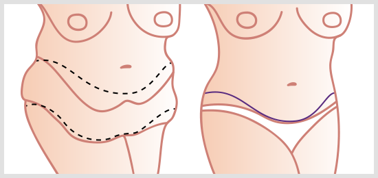 Body Lift Incisions