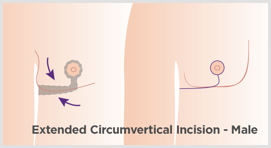 Extended incision for male chest lift