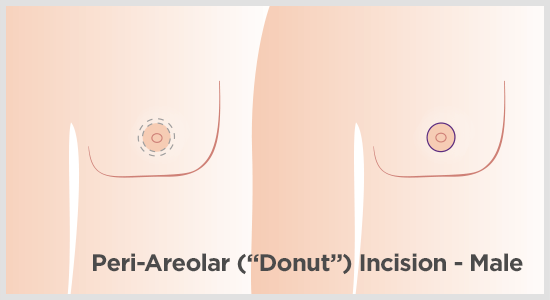 Peri-areolar incision for male breast reduction