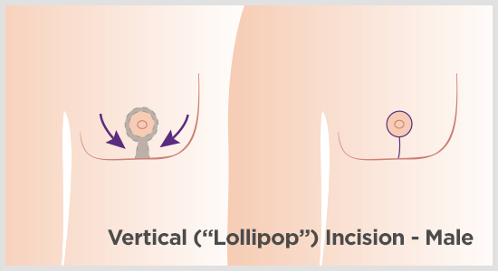 Vertical incision for male breast reduction