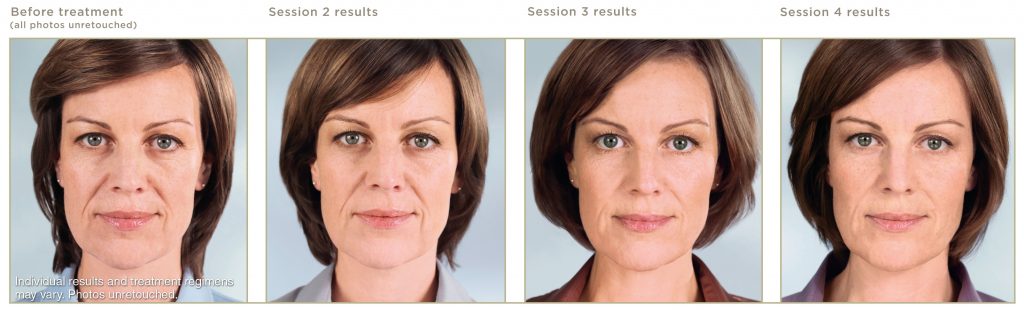 Sculptra injections in Granite Bay