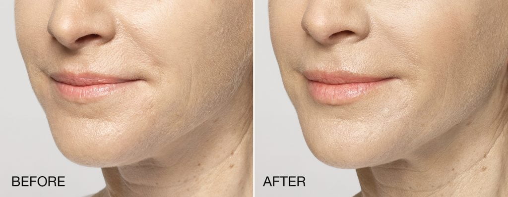 Before & after Restylane Silk injections. Photos courtesy Galderma, inc.