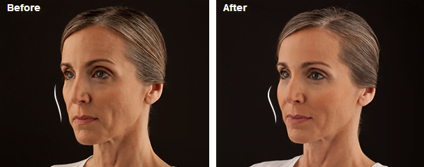 Before & After VOLUMA XC. Photos courtesy Allergan, inc.