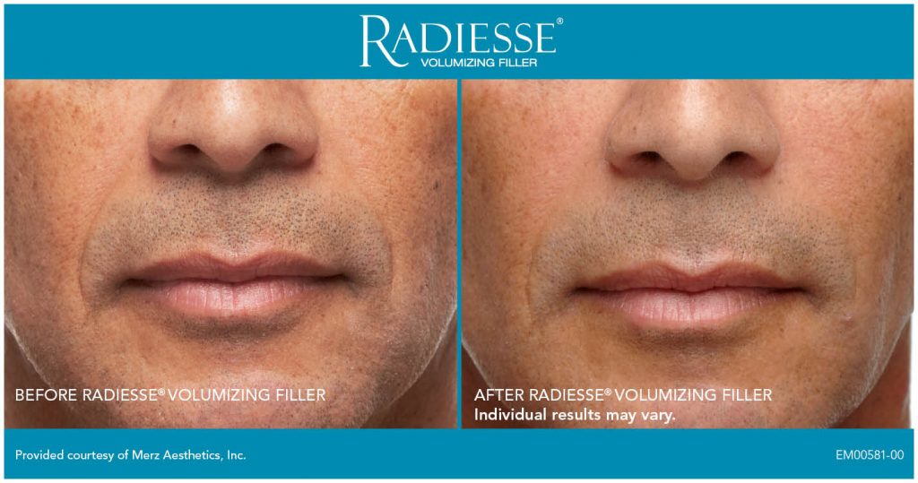 Radiesse injections in Granite Bay