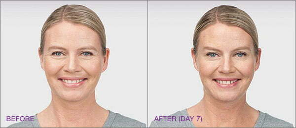 Granite Bay Botox injections