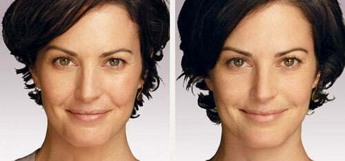 Before & after Juvederm injections. Photos courtesy Allergan, inc.