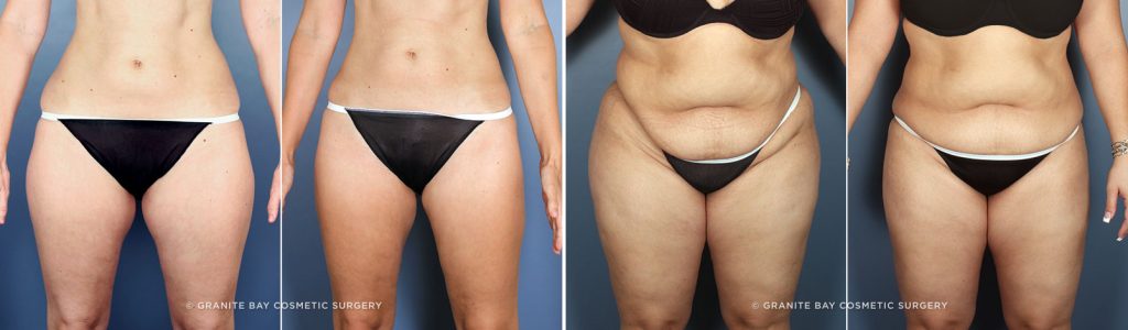 Liposuction Patient B&A