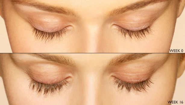 Before and after Latisse eyelash solution