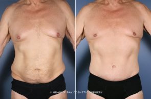 body-lift-chest-liposuction-9815a-clark