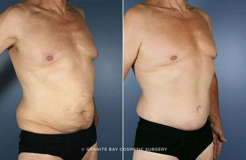 body-lift-chest-liposuction-9815b-clark