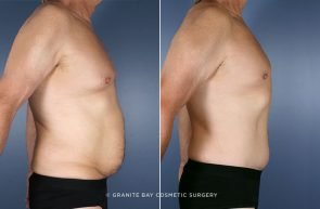 body-lift-chest-liposuction-9815c-clark