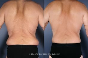 body-lift-chest-liposuction-9815d-clark