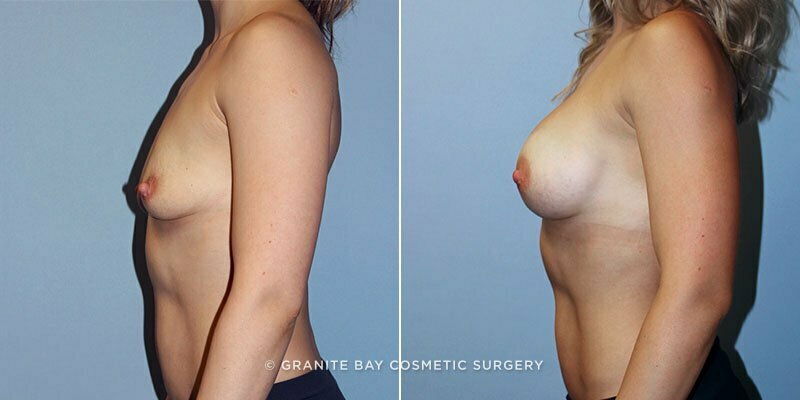 breast-augmentation-8807c-clark