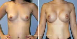 breast-augmentation-9100a-clark