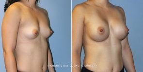 breast-augmentation-9100b-clark