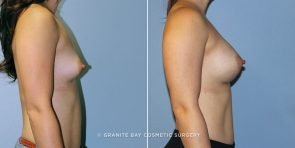 breast-augmentation-9100c-clark