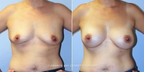 breast-augmentation-9140a-clark