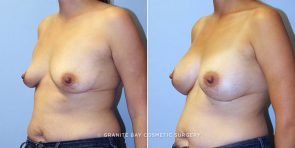 breast-augmentation-9140b-clark