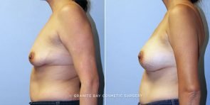 breast-augmentation-9140c-clark