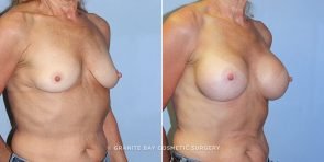 breast-augmentation-9147b-clark