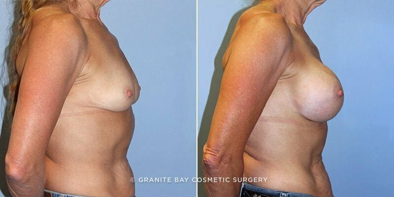 breast-augmentation-9147c-clark