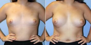 breast-augmentation-9161a-clark