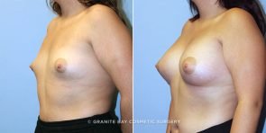 breast-augmentation-9161b-clark