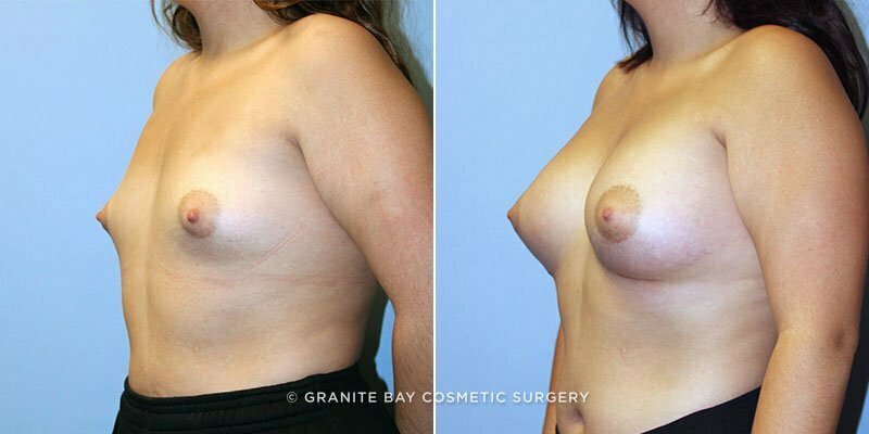 breast-augmentation-9161b-clark