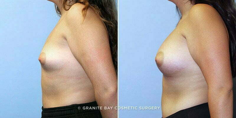 breast-augmentation-9161c-clark