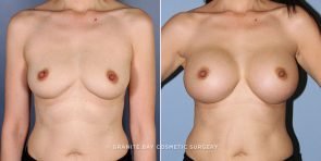 breast-augmentation-9175a-clark