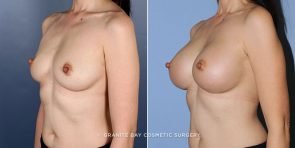 breast-augmentation-9175b-clark