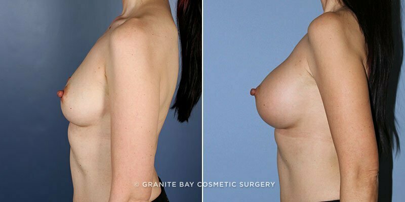 breast-augmentation-9175c-clark