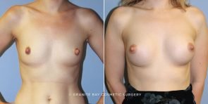 breast-augmentation-9182a-clark
