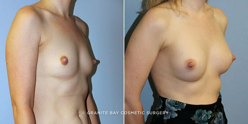 breast-augmentation-9182b-clark
