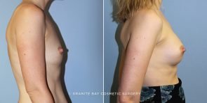 breast-augmentation-9182c-clark