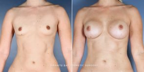 breast-augmentation-9189a-clark