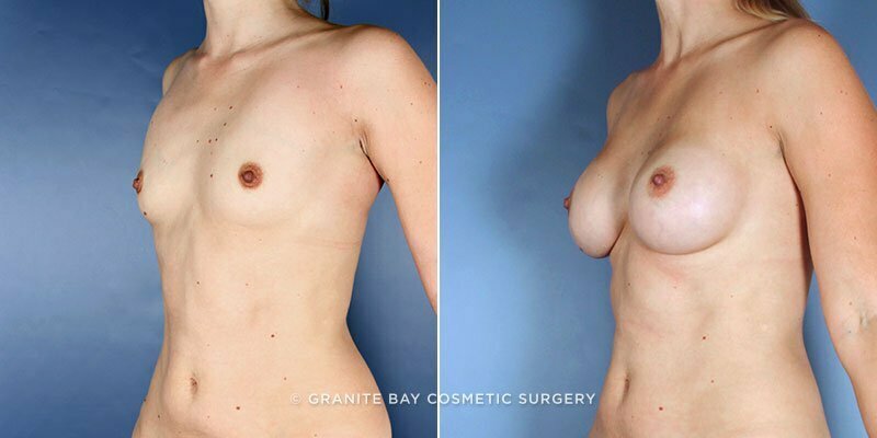 breast-augmentation-9189b-clark