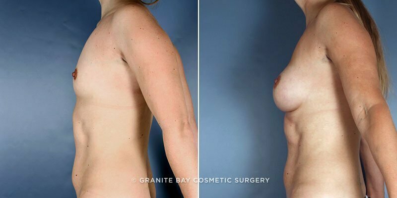 breast-augmentation-9189c-clark