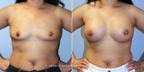 breast-augmentation-9217a-clark