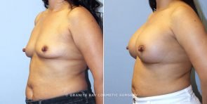breast-augmentation-9217b-clark