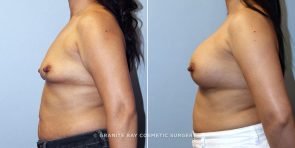 breast-augmentation-9217c-clark